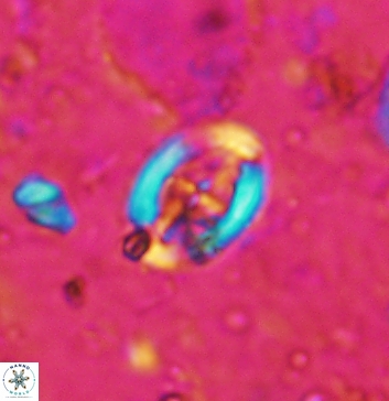Acaenolithus undatus 5893