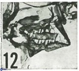 Calciosolenia aperta 69485