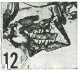Calciosolenia aperta 69485