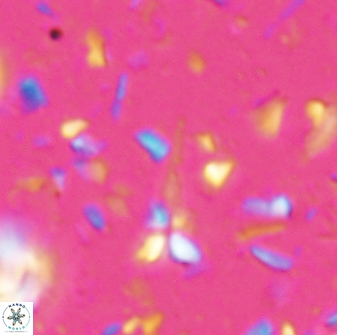 Sphenolithus microdelphix 28085