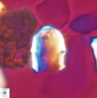 Lapideacassis glans 9446