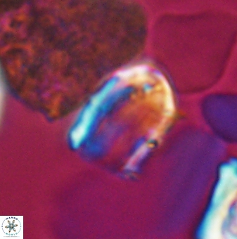 Lapideacassis glans 9450